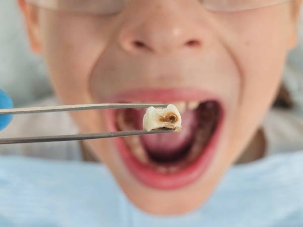 Best Emergency Tooth Extraction in Springfield, NJ